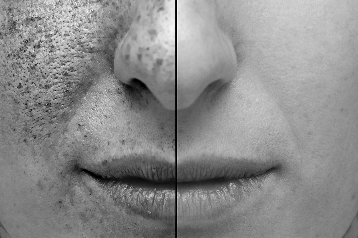 face divided in half with damaged skin on one side and clear skin on the other