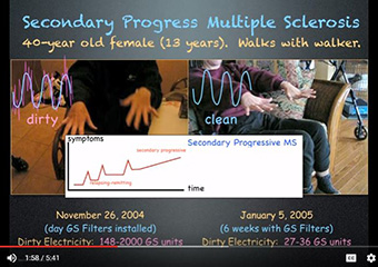 Secondary Progress Mutliple Sclerosis slide