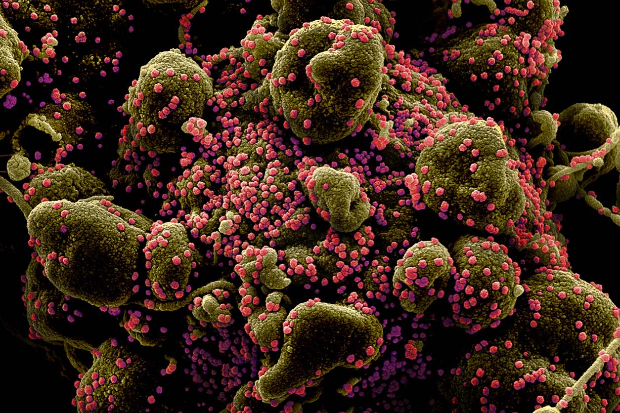 colorized micrograph of a cell heavily infected with SARS-CoV-2 virus particles