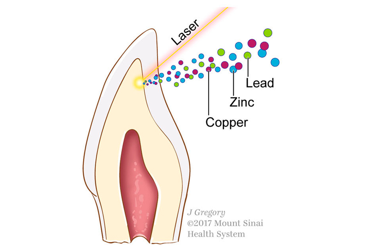 diagram of lasers used on baby teeth showing copper, zinc, and lead