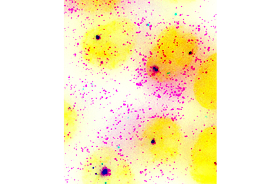 Fluorescent image of stained breast cancer cells displays nuclei (yellow)