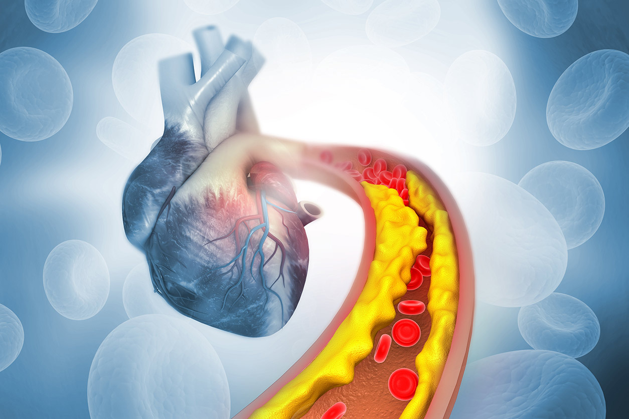 3D Illustration of cholesterol plaque in artery with human heart.