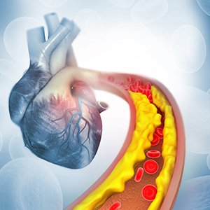 3D Illustration of cholesterol plaque in artery with human heart.